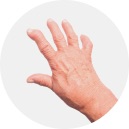 Cos'è l'artrite reumatoide?