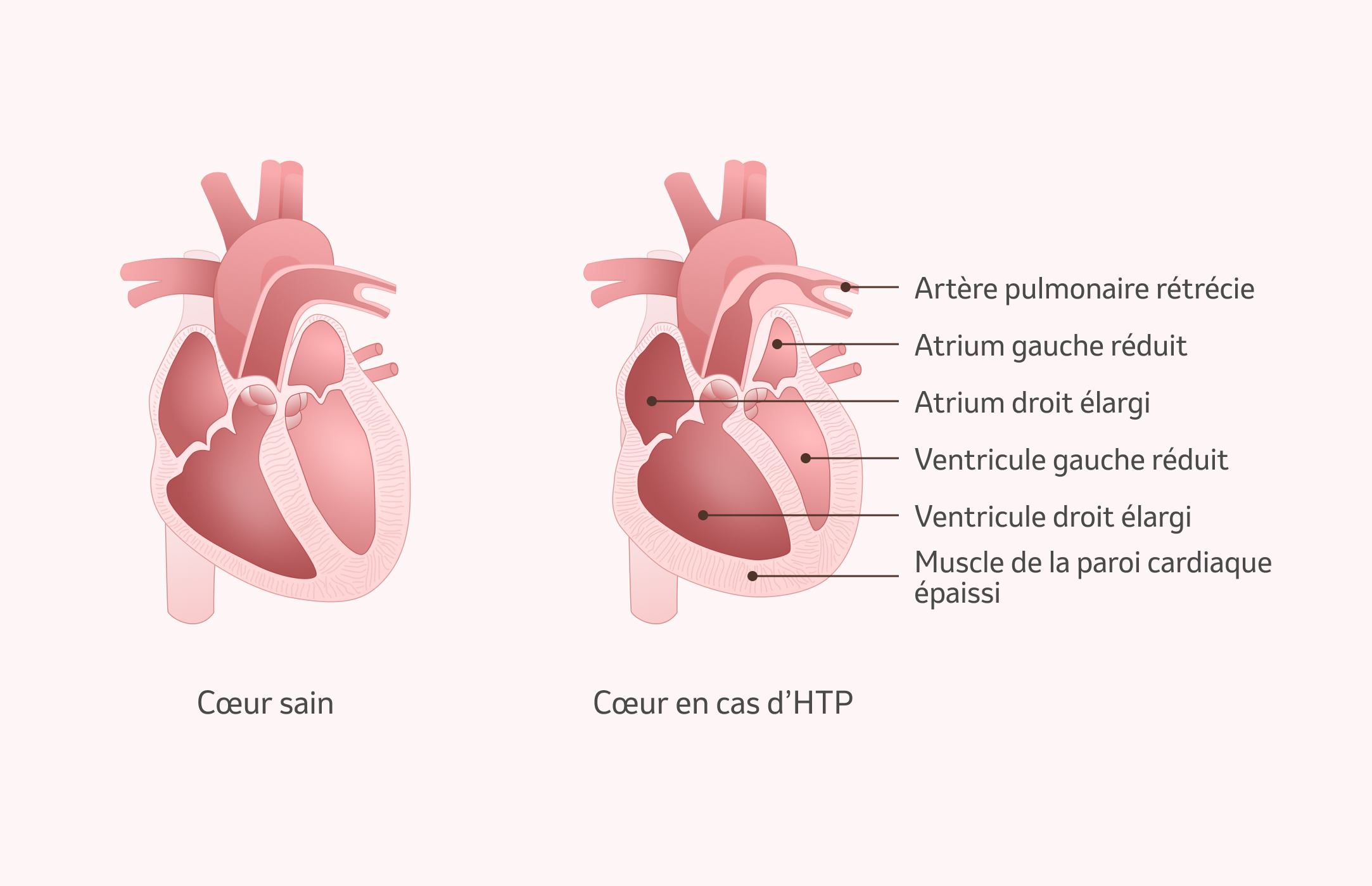 Image : conséquences de l'hypertension pulmonaire sur le cœur