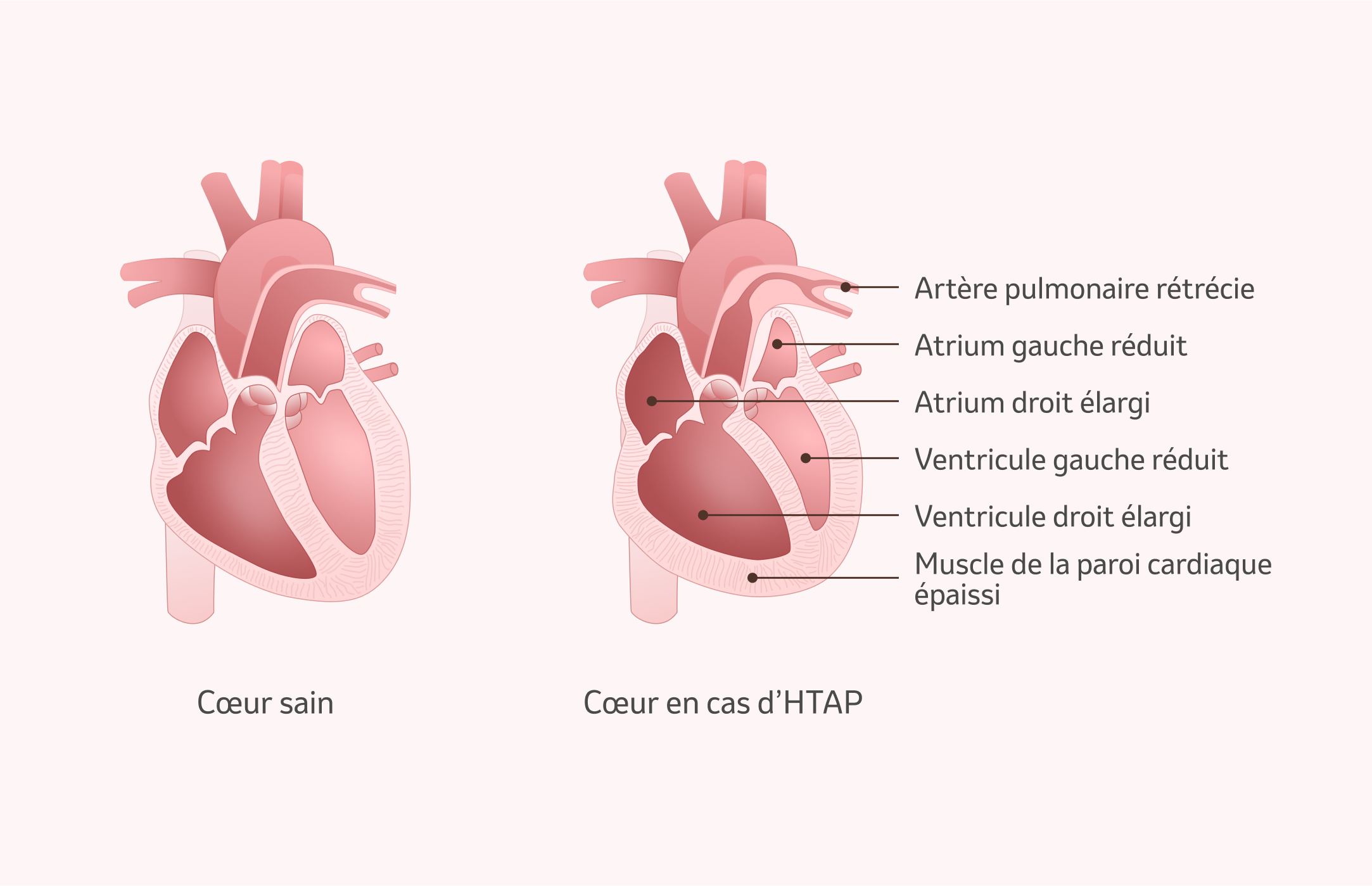 Image : Conséquences de l'HTAP sur le cœur