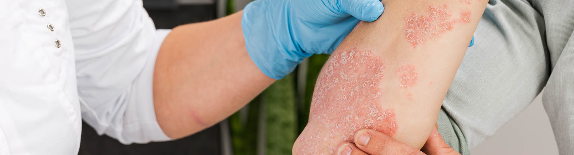 Ärztin untersucht Psoriasis am Ellbogen eines Patienten