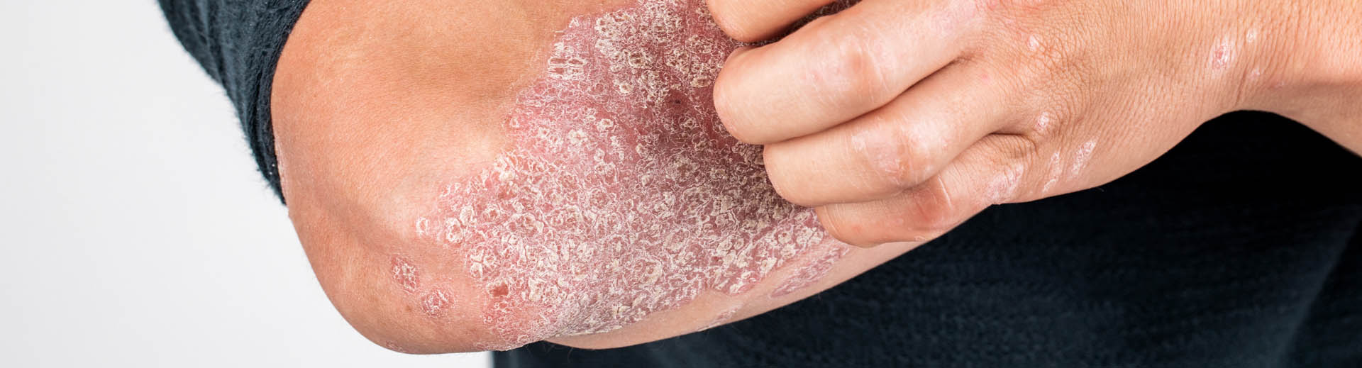 Un homme se gratte le coude avec du psoriasis