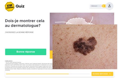 Mélanome