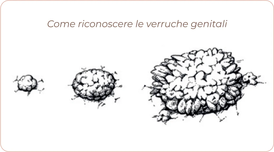 HPV Genital warts info