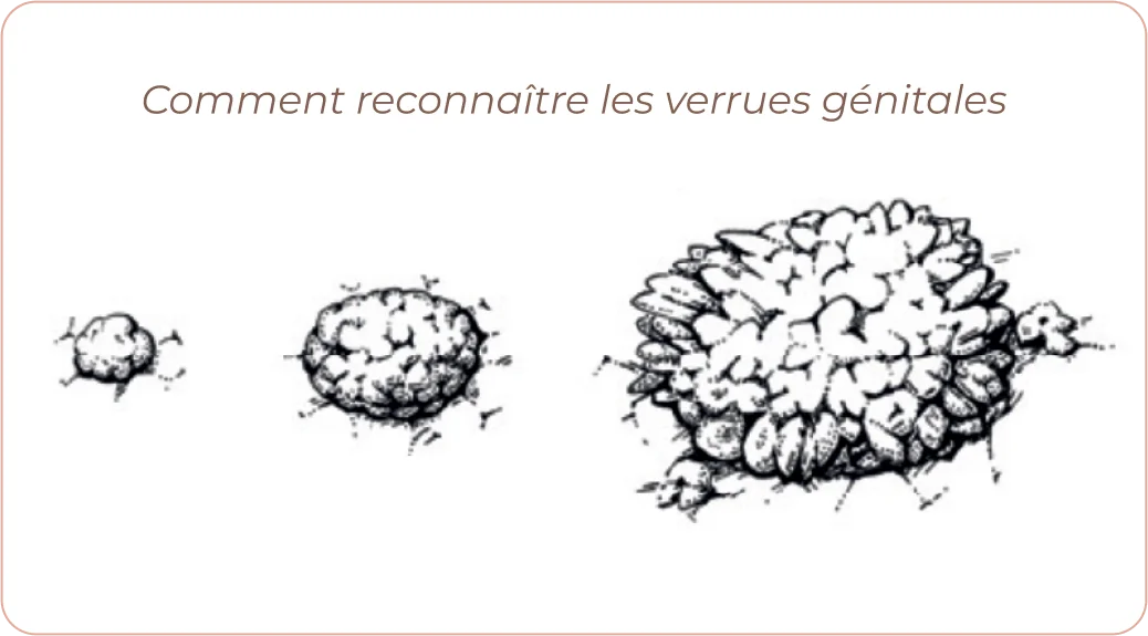HPV Genital warts info