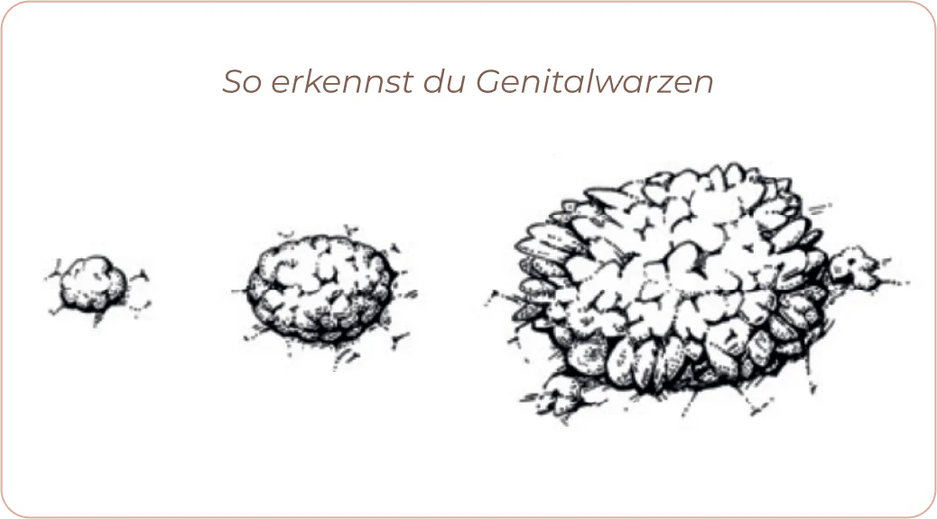 HPV genital warts info