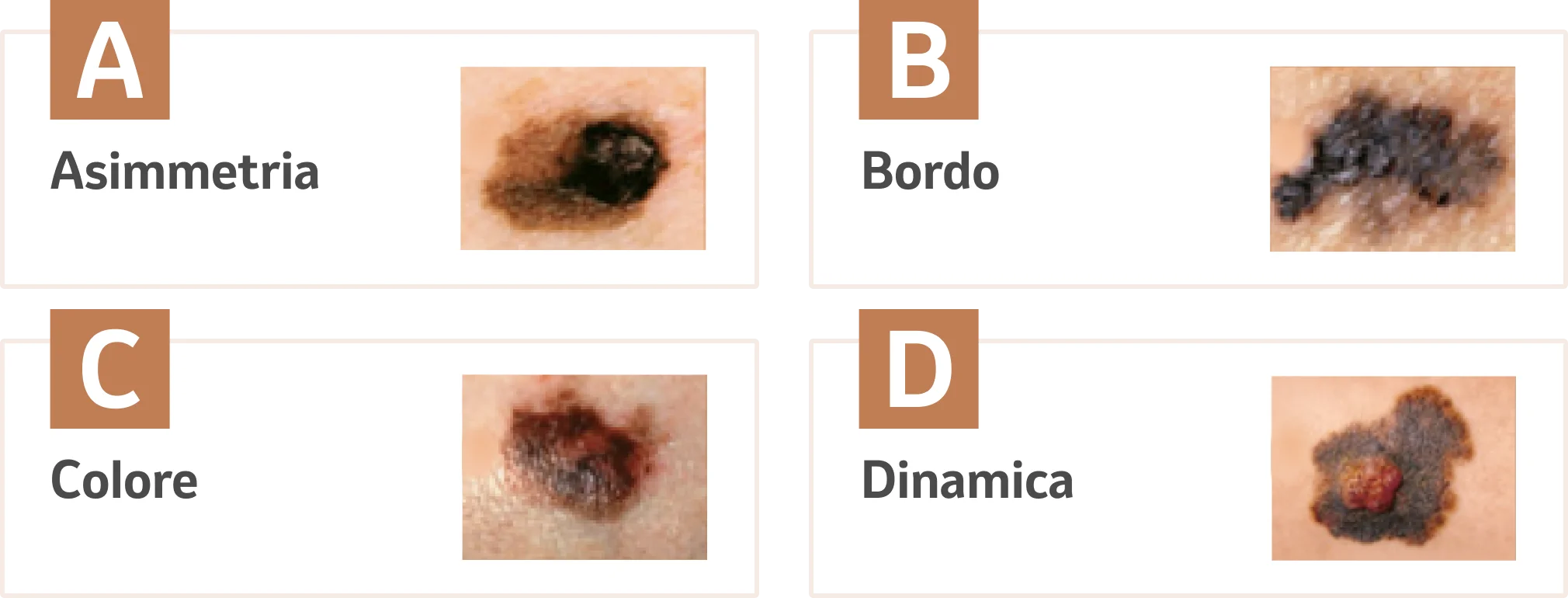 ABCD Melanoma