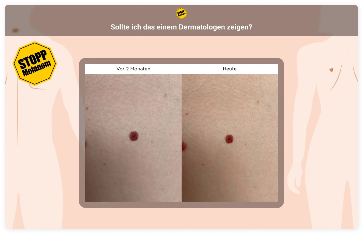 melanom quiz