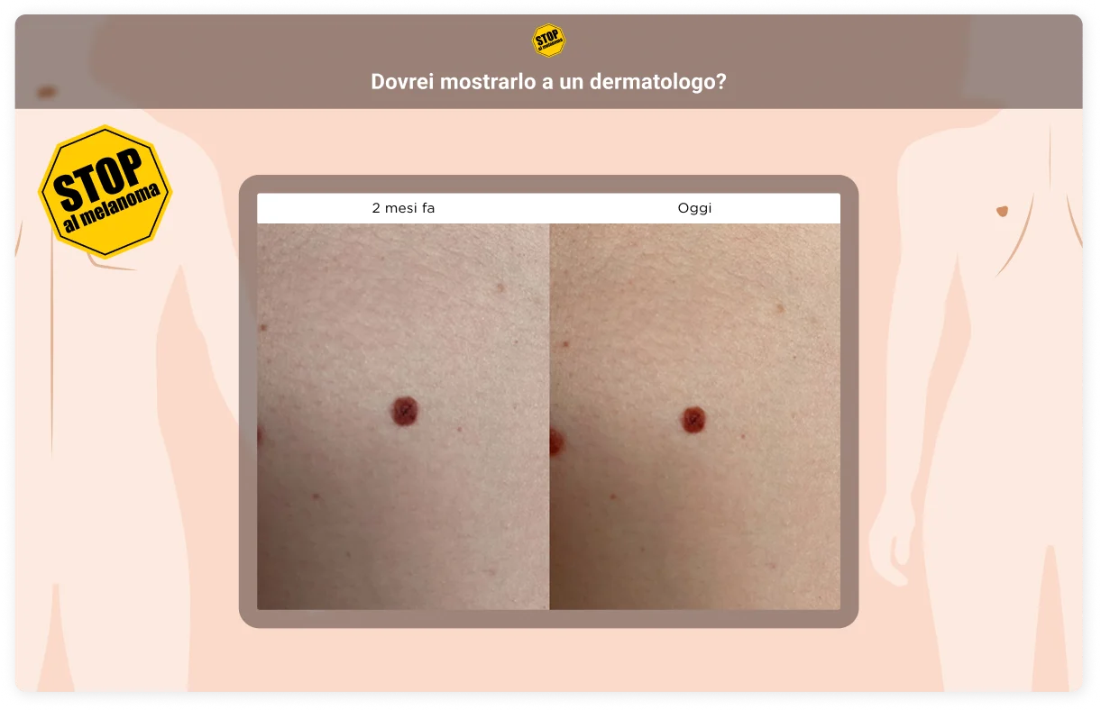 melanoma quiz