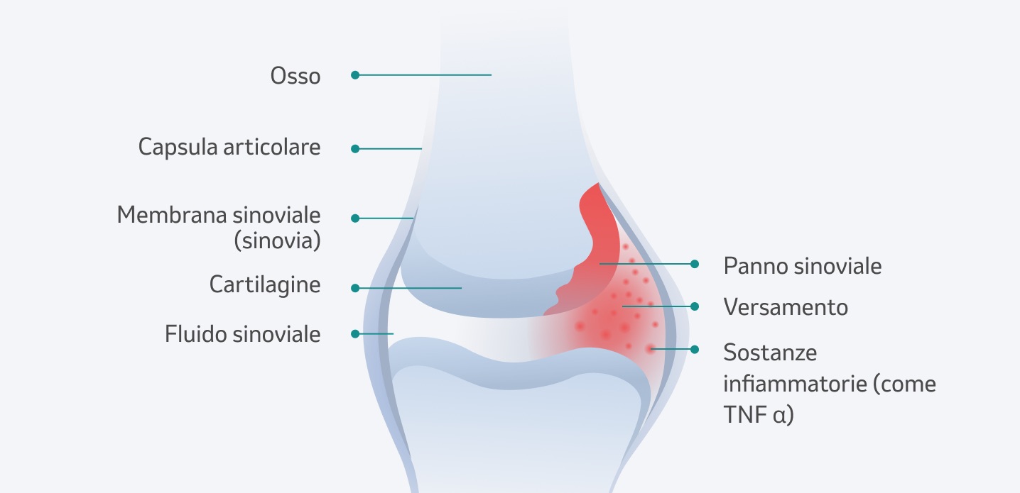 Alterazioni delle articolazioni associate all'artrite