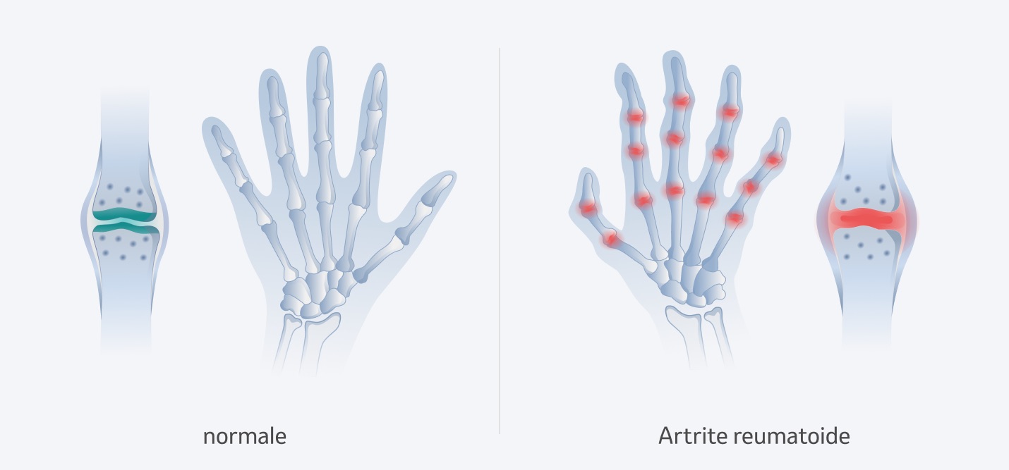 Artrite reumatoide alla mano