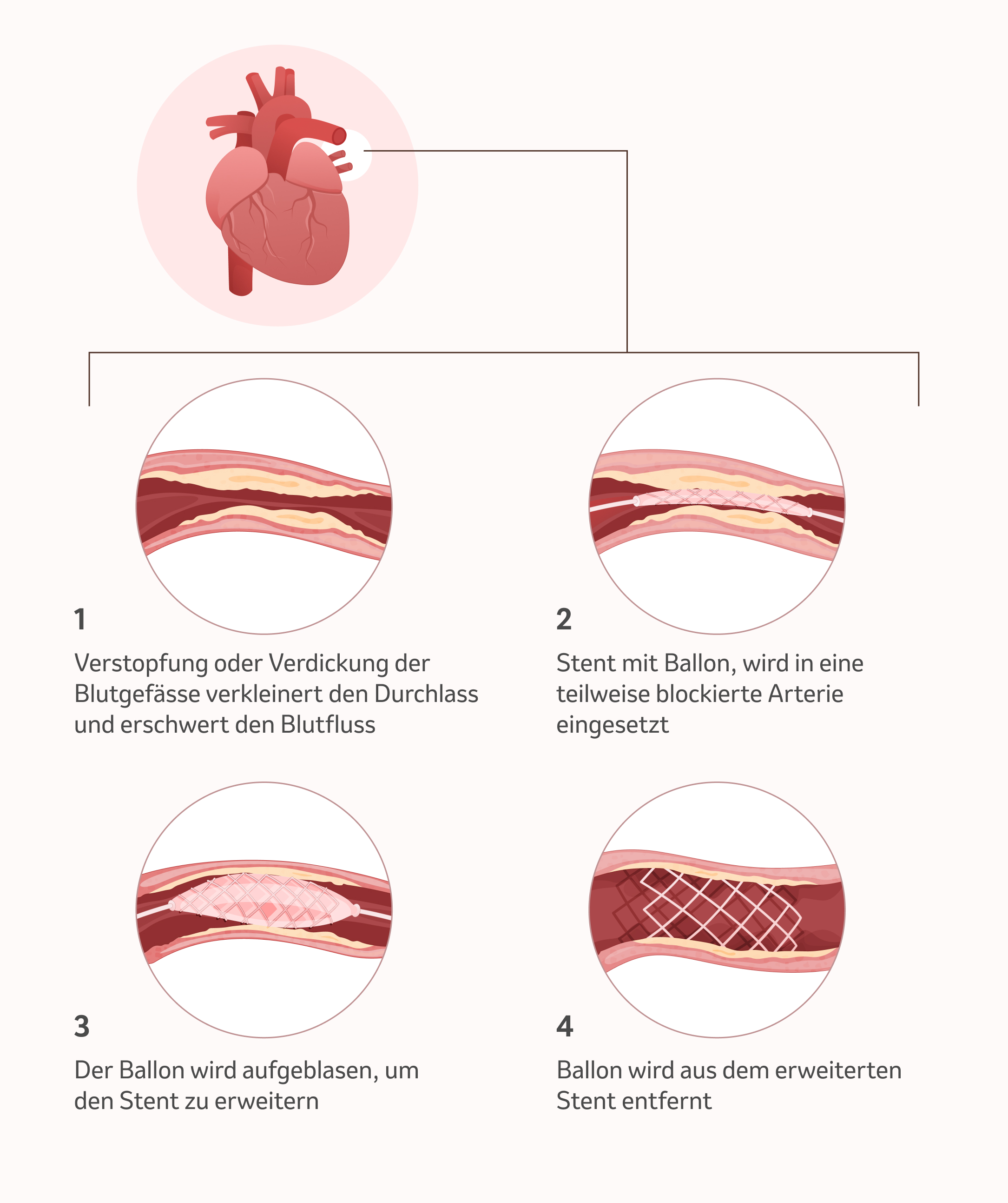 Bild: Die pulmonale Ballonangioplastie