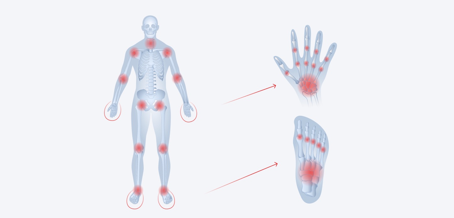 Befallsmuster der rheumatoiden Arthritis