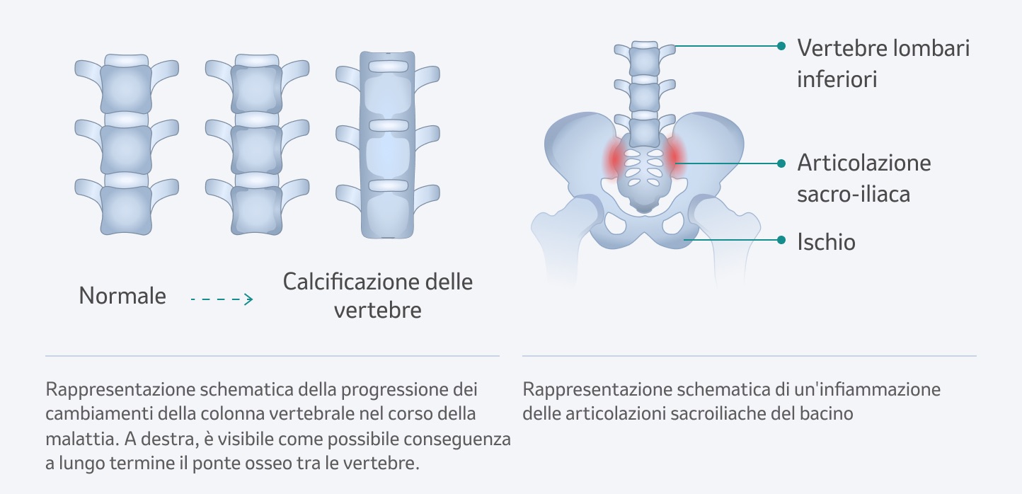 Cambiamenti della colonna vertebrale