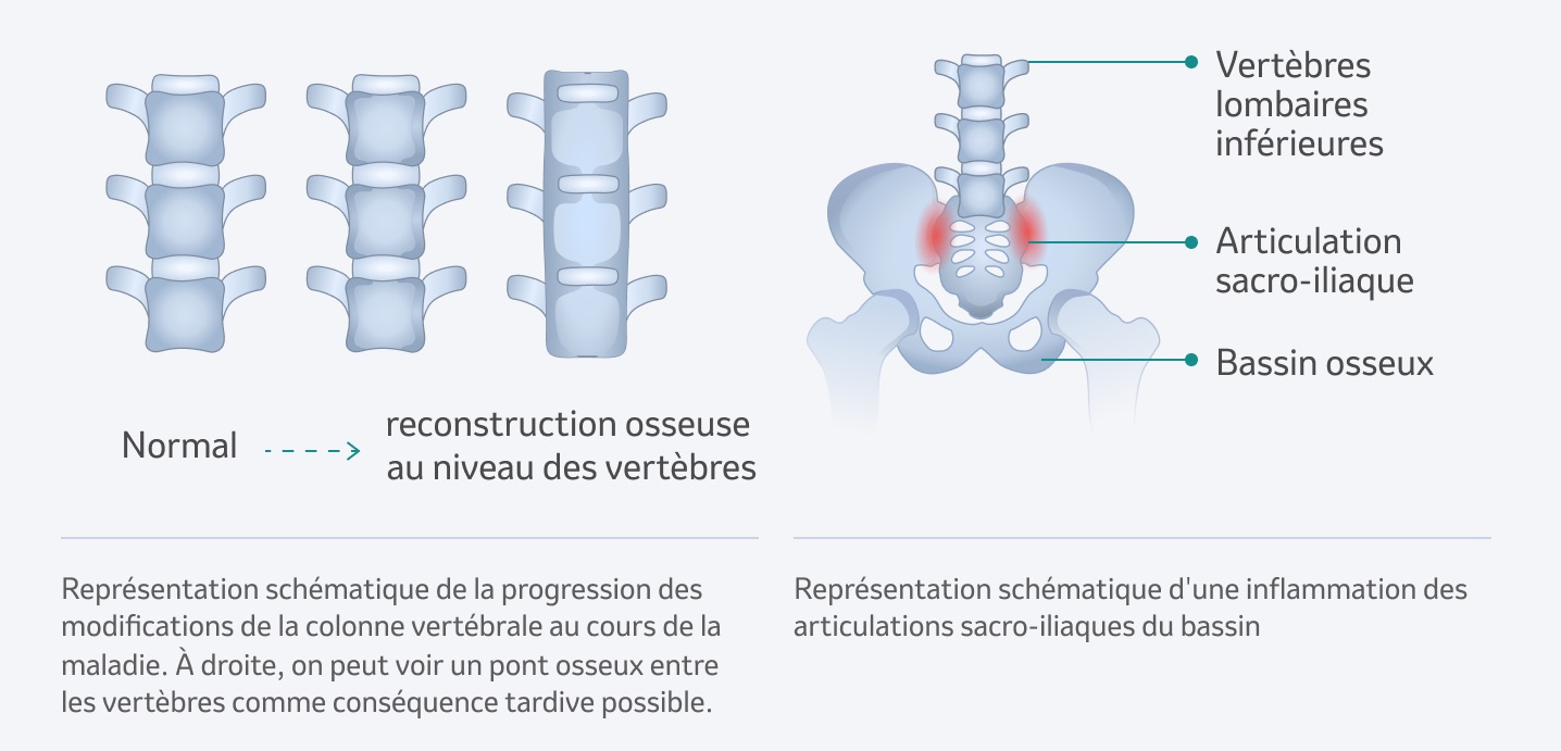 Spondylarthrite axiale, y compris maladie de Bechterew ...