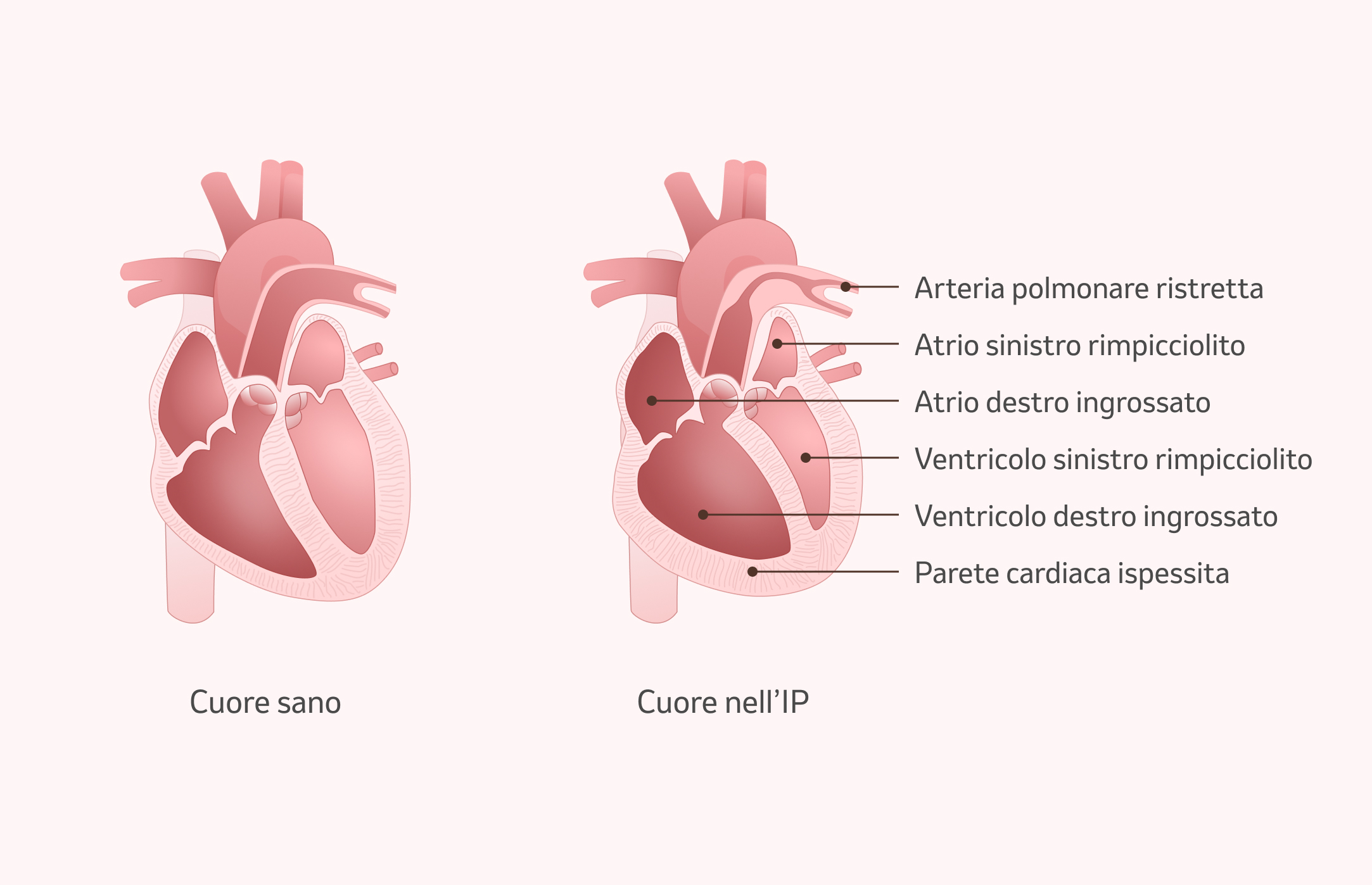 Immagine: Conseguenze dell'ipertensione polmonare sul cuore