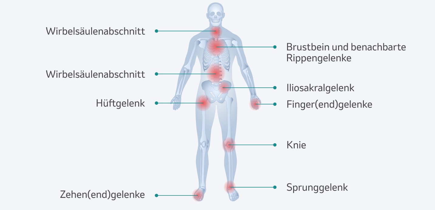 Entzündungsstellen bei Psoriasis-Arthritis