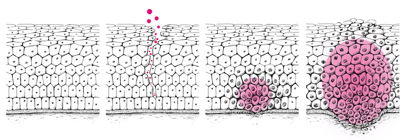 HPV Krebsentstehung