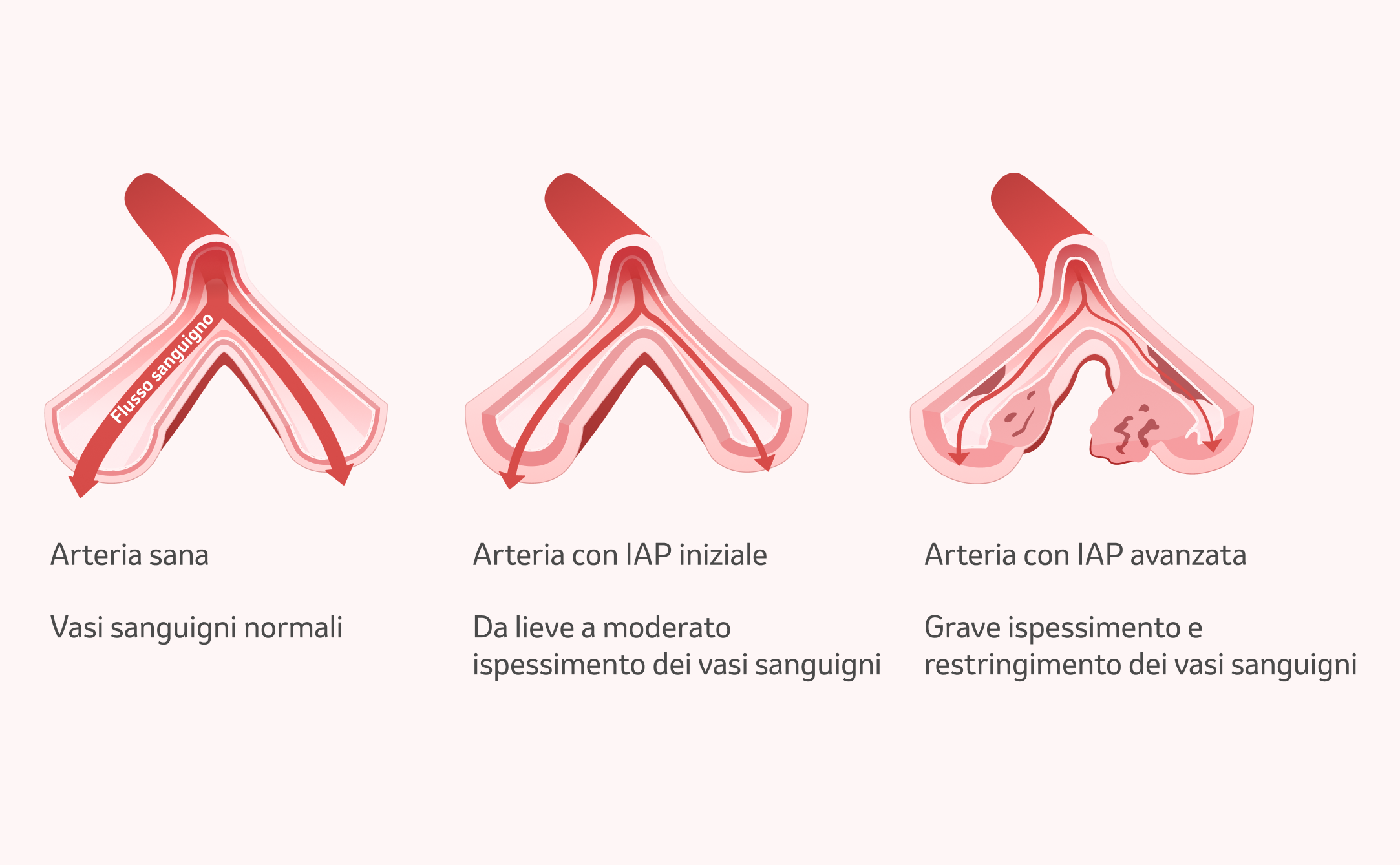 Immagine: Cambiamento delle arterie polmonari nell'IAP