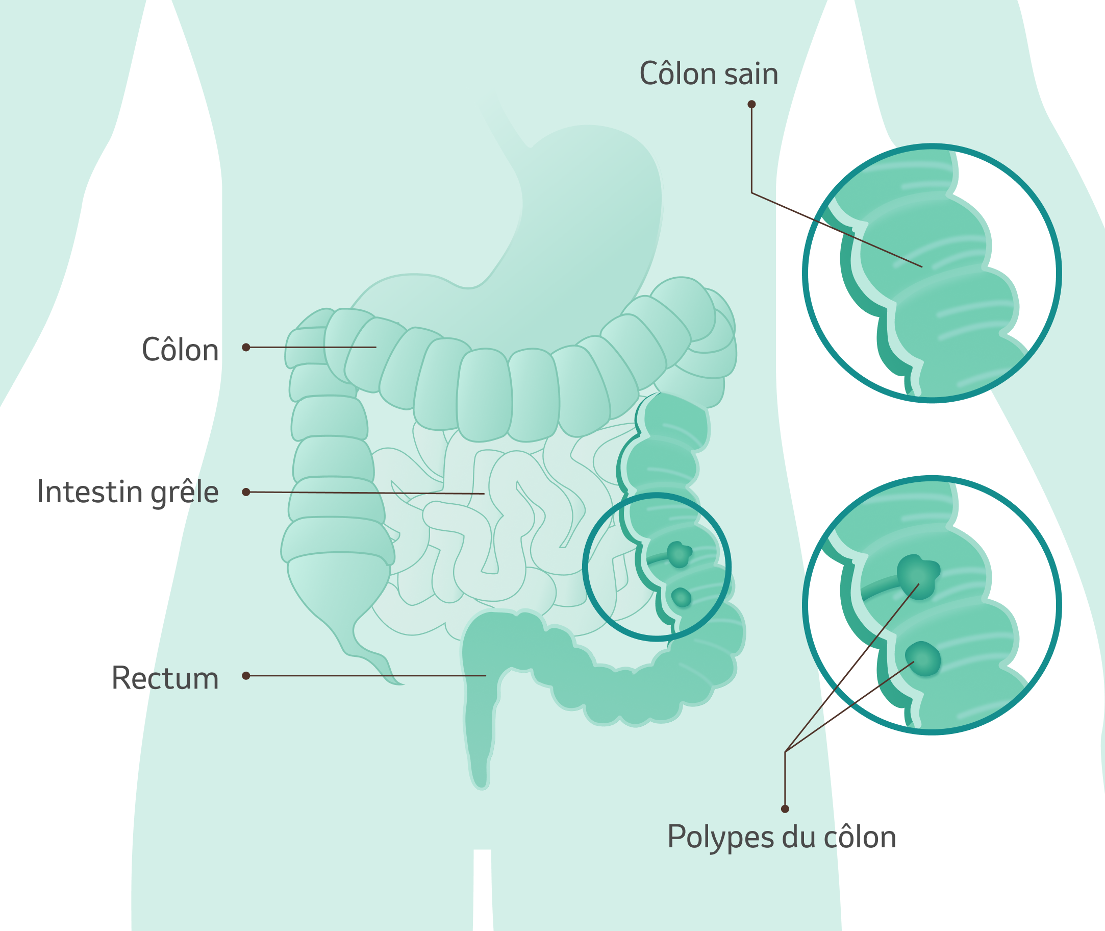 Cancer colorectal I MSD Santé Suisse