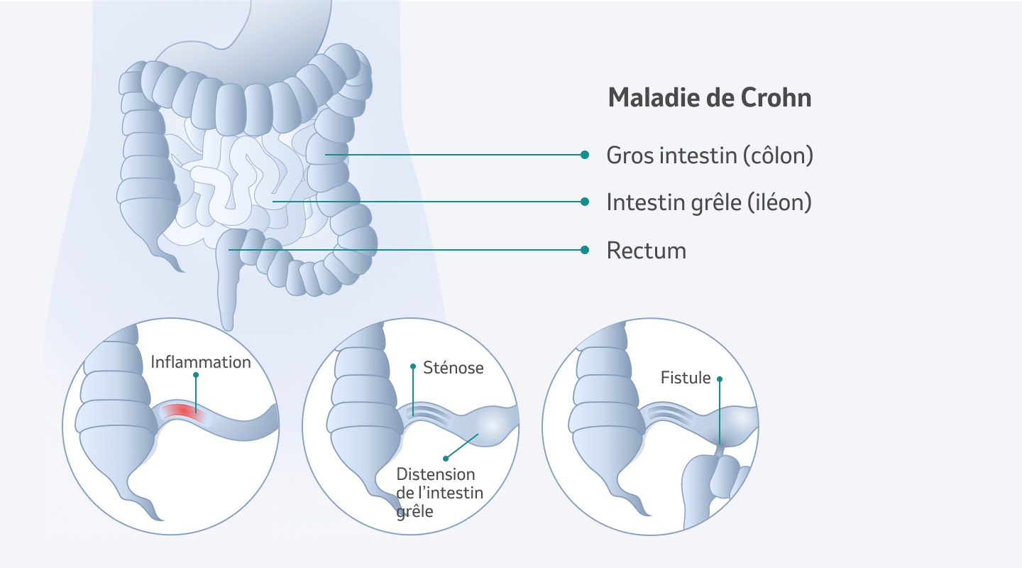 Illustration Morbus Crohn