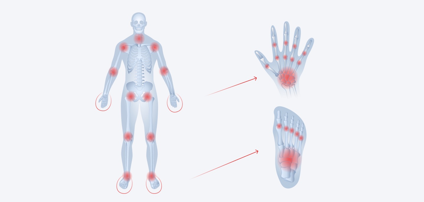 Modèle de diffusion de la polyarthrite rhumatoïde