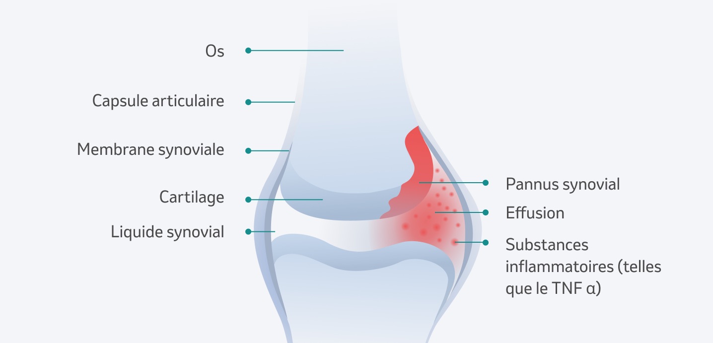 Modifications des articolations en cas d'arthrite