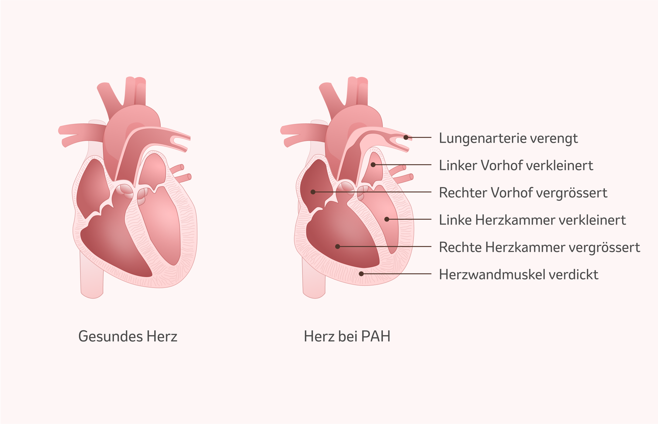 Bild:  Folgen der PAH auf das Herz
