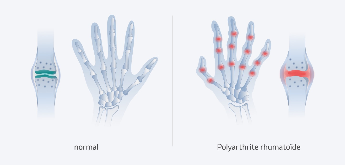 Polyarthrite rhumatoïde dans la main