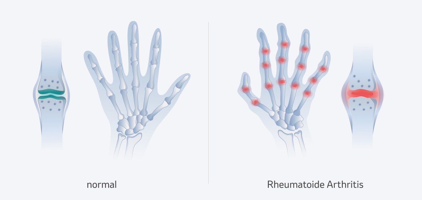 Rheumatoide Arthritis der Hände