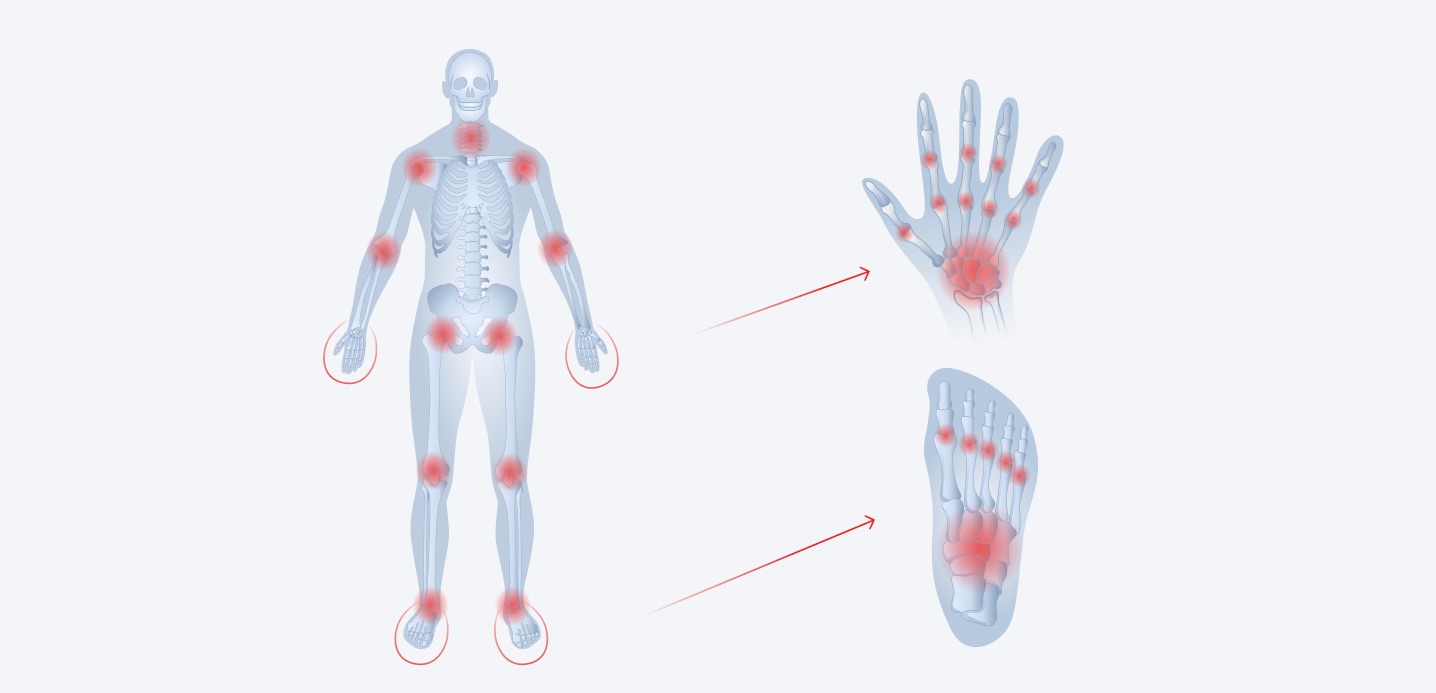 Schema di infiammazione da artrite reumatoide