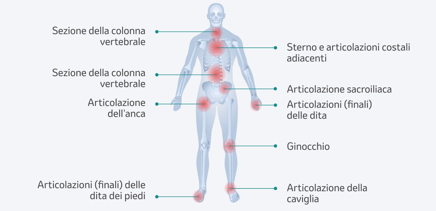 Sedi del processo infiammatorio nell'artrite psoriasica