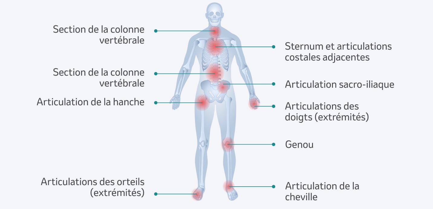 Sites d'inflammation en cas d'arthrite psoriasique