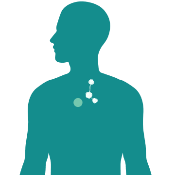 Illustrazione melanoma stadio III