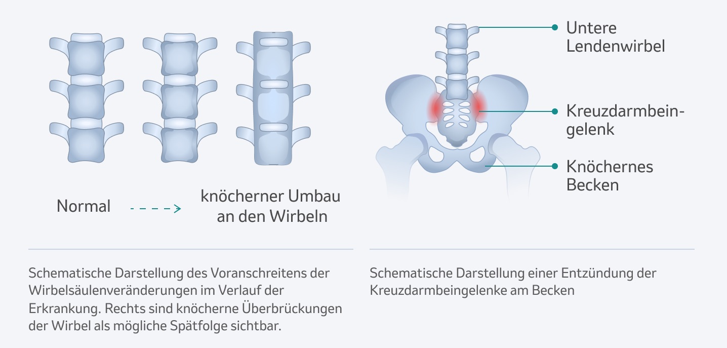 Veränderungen an der Wirbelsäule