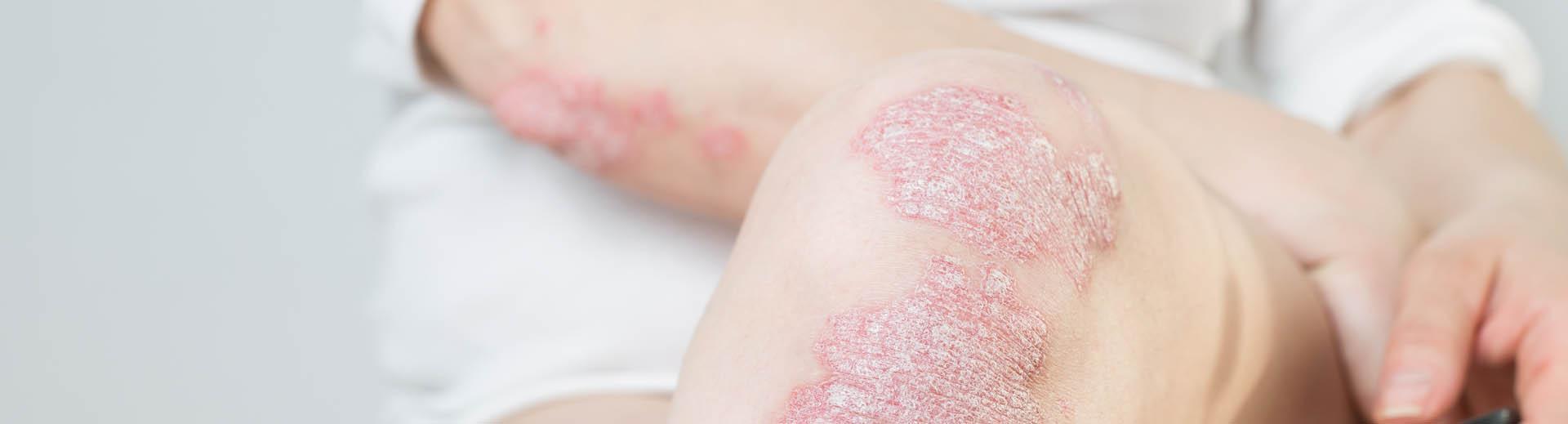 Femme souffrant de psoriasis au coude et au genou