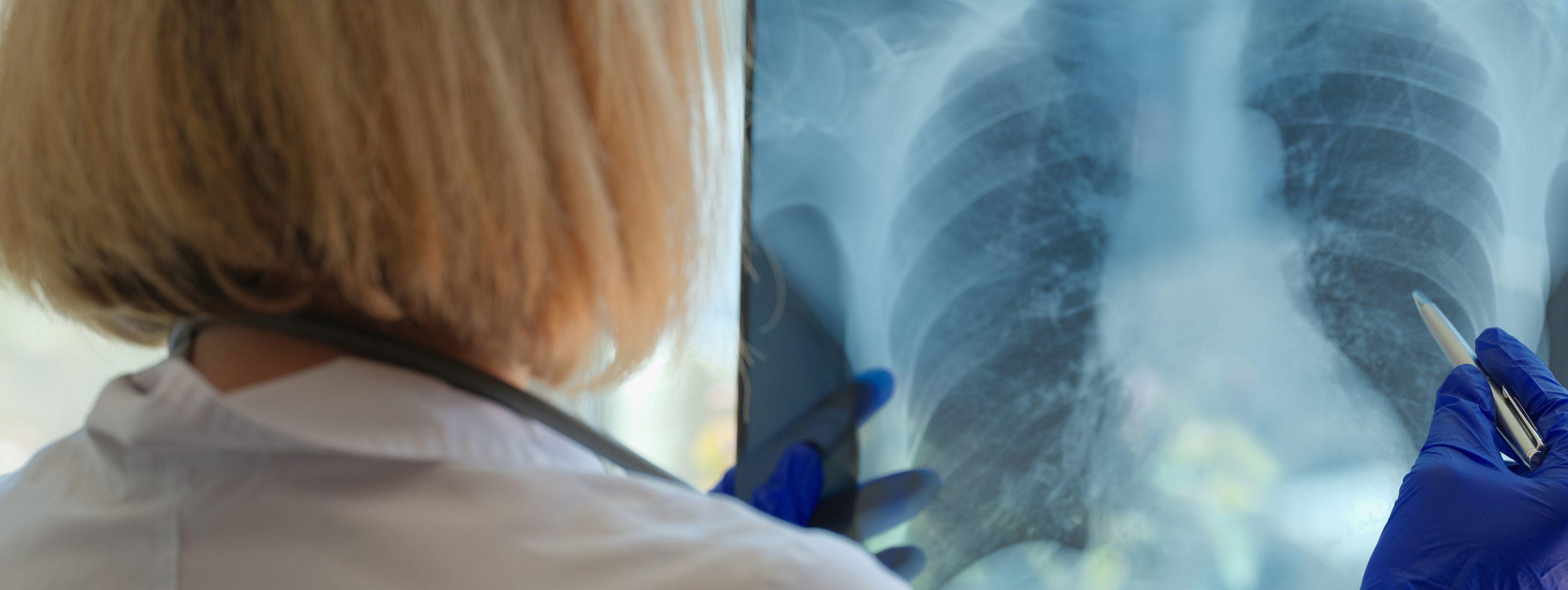 Una dottoressa osserva una radiografia dei polmoni